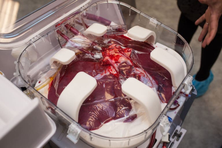 Donated organs kept ‘alive’ may ease the transplant shortage